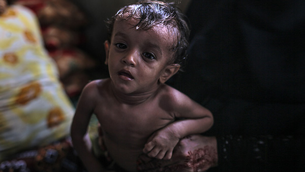 紛争の最中に生まれ、18ヶ月の今も栄養失調状態にある赤ちゃん。燃料費の高騰で、母親は病院に連れて行くこともできません。 ©Rawan Shaif