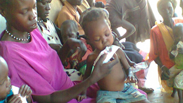 栄養治療食で食欲テストを受ける栄養不良の子ども：重度急性栄養不良の特徴である浮腫：むくみが見られる（南スーダン）©Word Vision